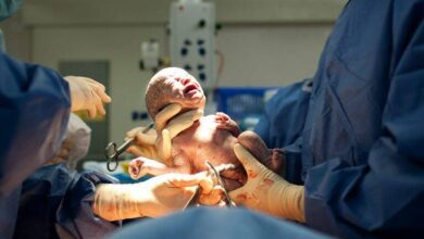 الولادة القيصرية و متى تتعافى من ولادة قيصرية