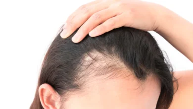هل يمكنني منع تساقط الشعر بعد تكميم المعدة جراحة السمنة؟